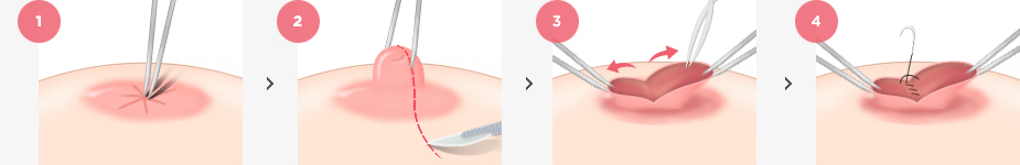 Inverted Nipple Correction Surgery Method
